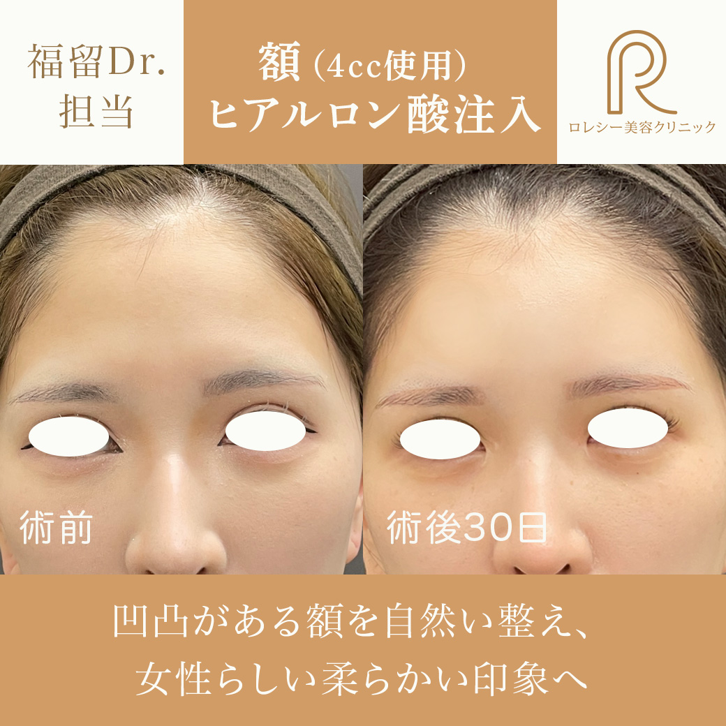 おでこ・額〜こめかみヒアルロン酸注入症例写真