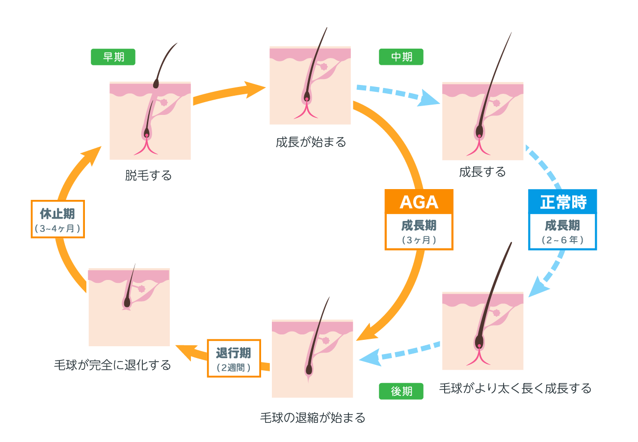 AGAのヘアサイクル