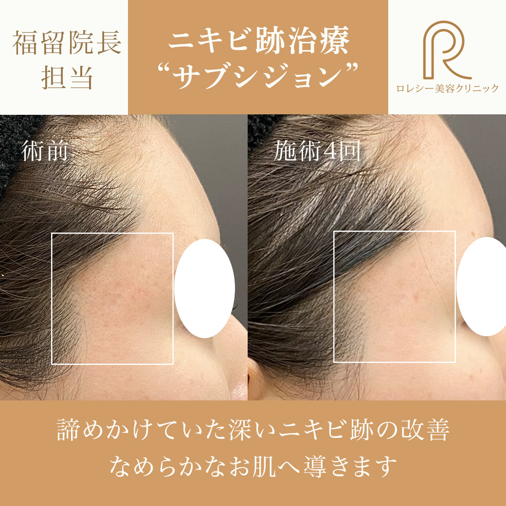 トゥインクルリフト12本症例写真