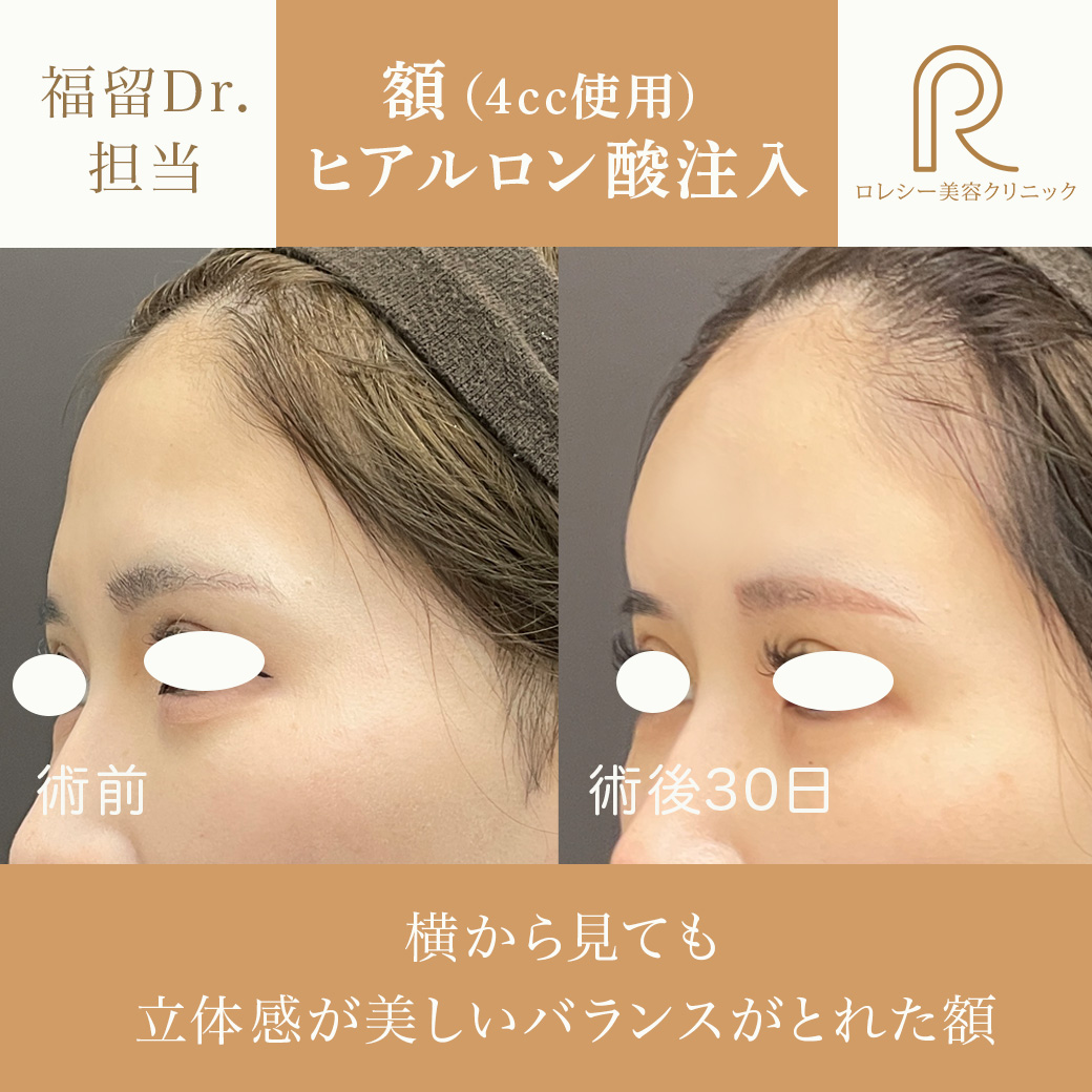 おでこ・額〜こめかみヒアルロン酸注入症例写真