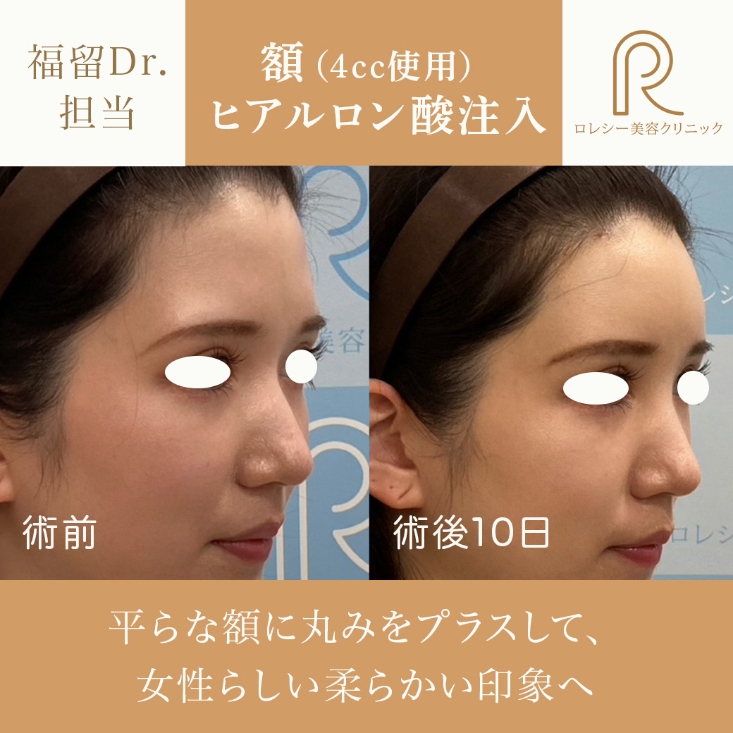 額〜こめかみヒアルロン酸注入症例写真