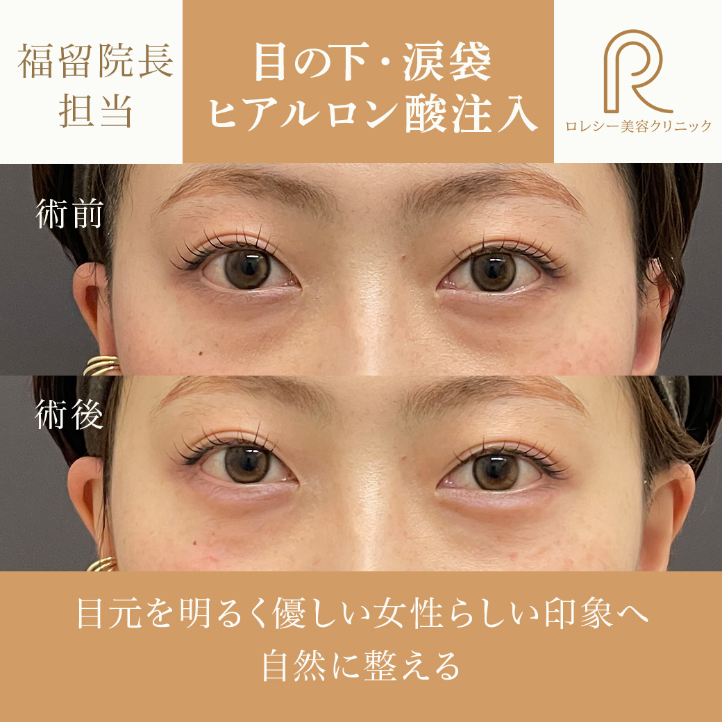 目の下ヒアルロン酸注入症例写真