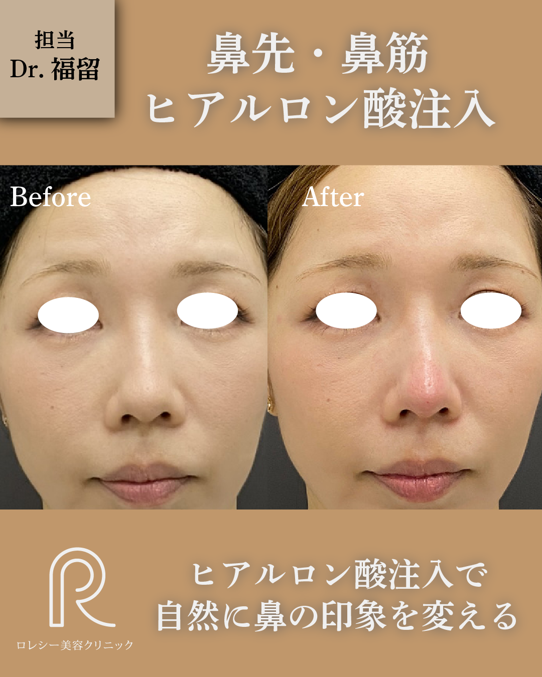 鼻先鼻筋ヒアルロン酸注入症例写真