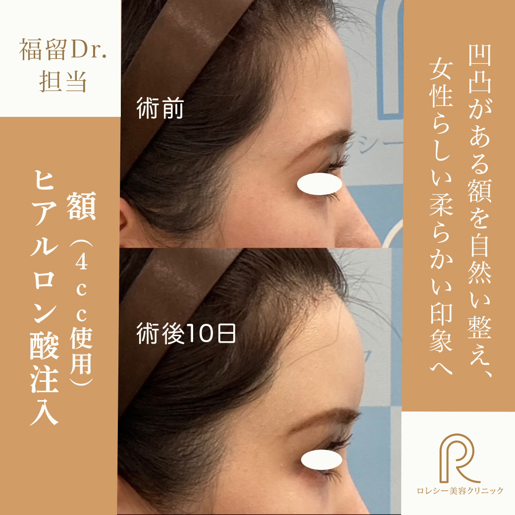 額〜こめかみヒアルロン酸注入症例写真