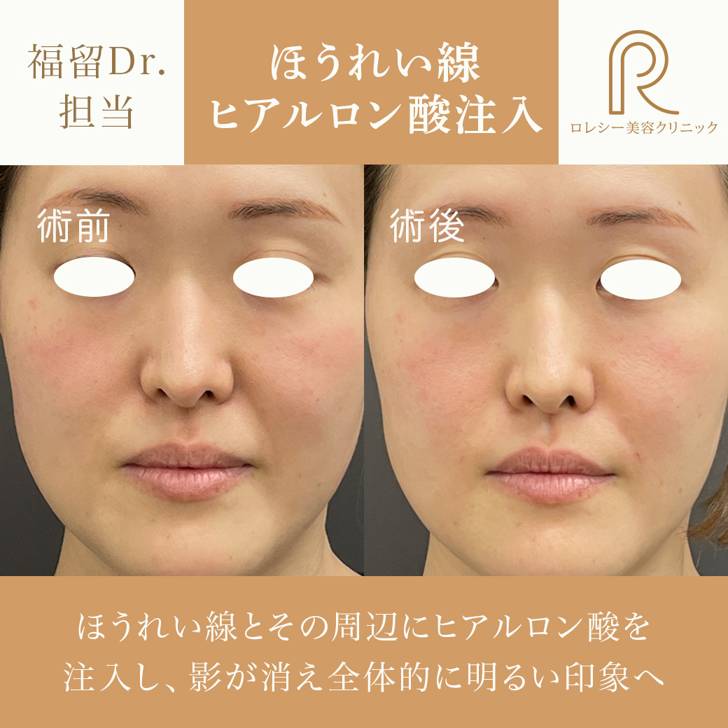 しわたるみほうれい線改善ヒアルロン酸注入症例写真