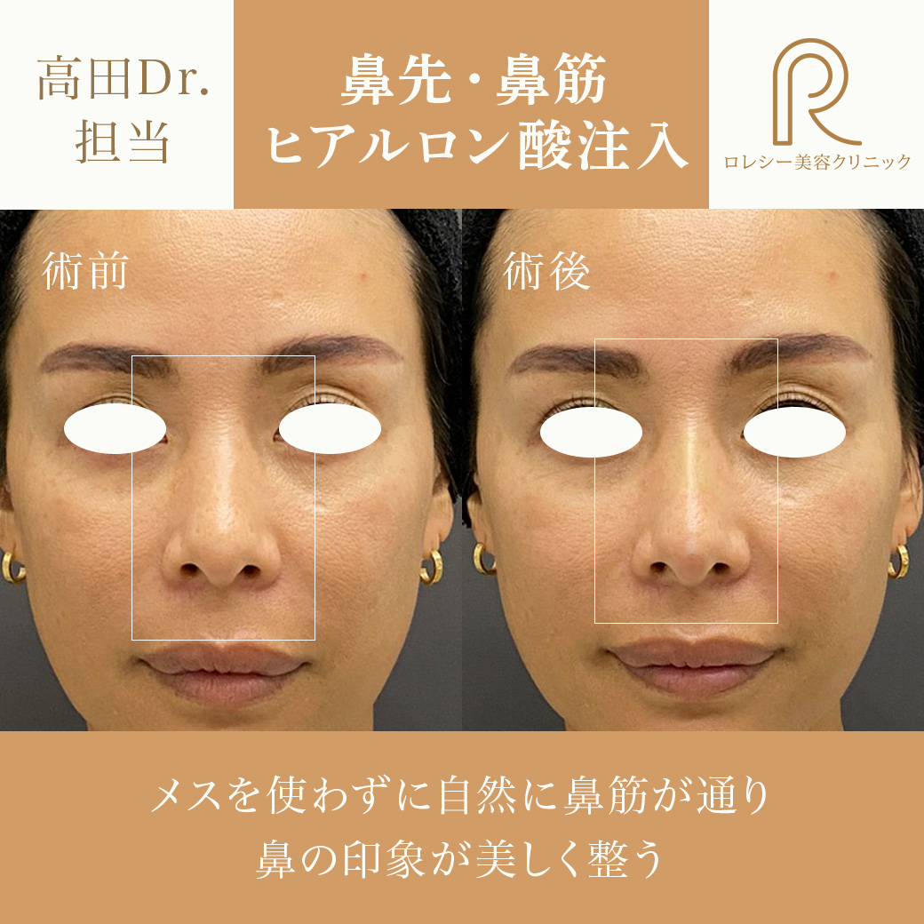 鼻先鼻筋ヒアルロン酸注入症例写真