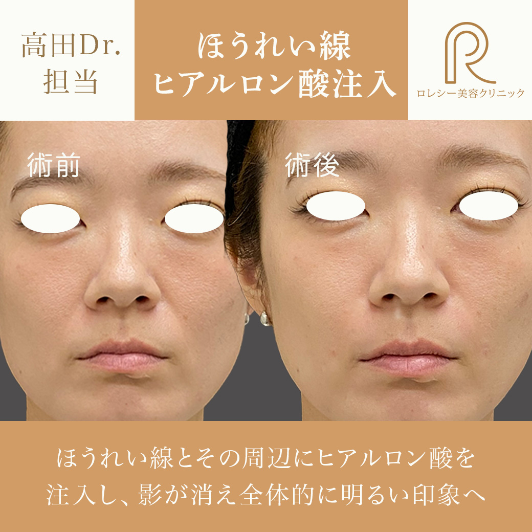 しわたるみほうれい線改善ヒアルロン酸注入症例写真