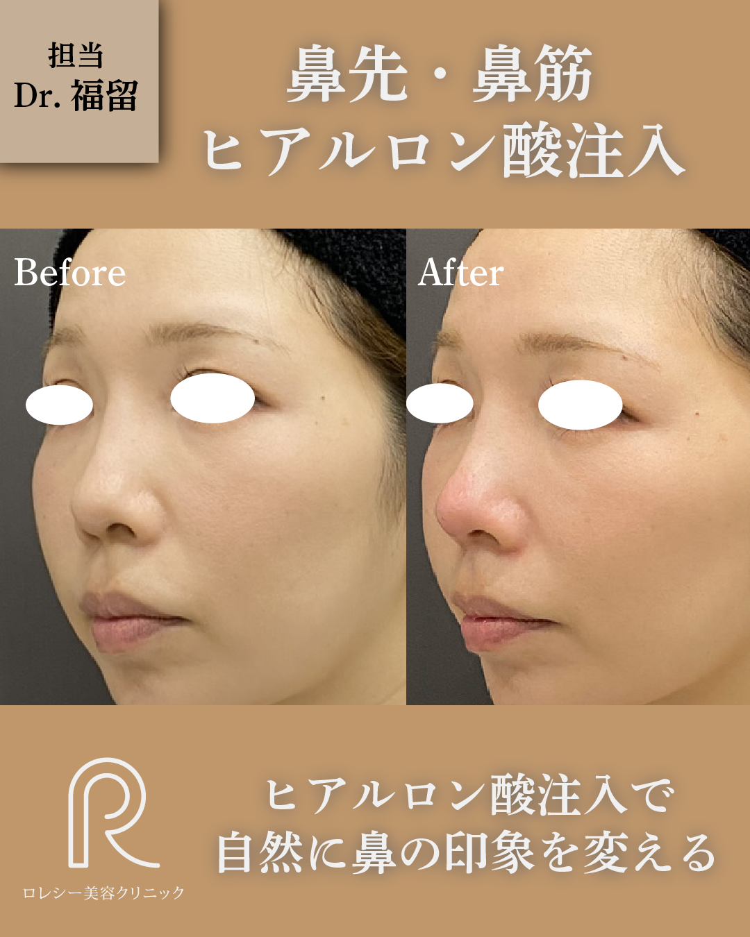 鼻先鼻筋ヒアルロン酸注入症例写真
