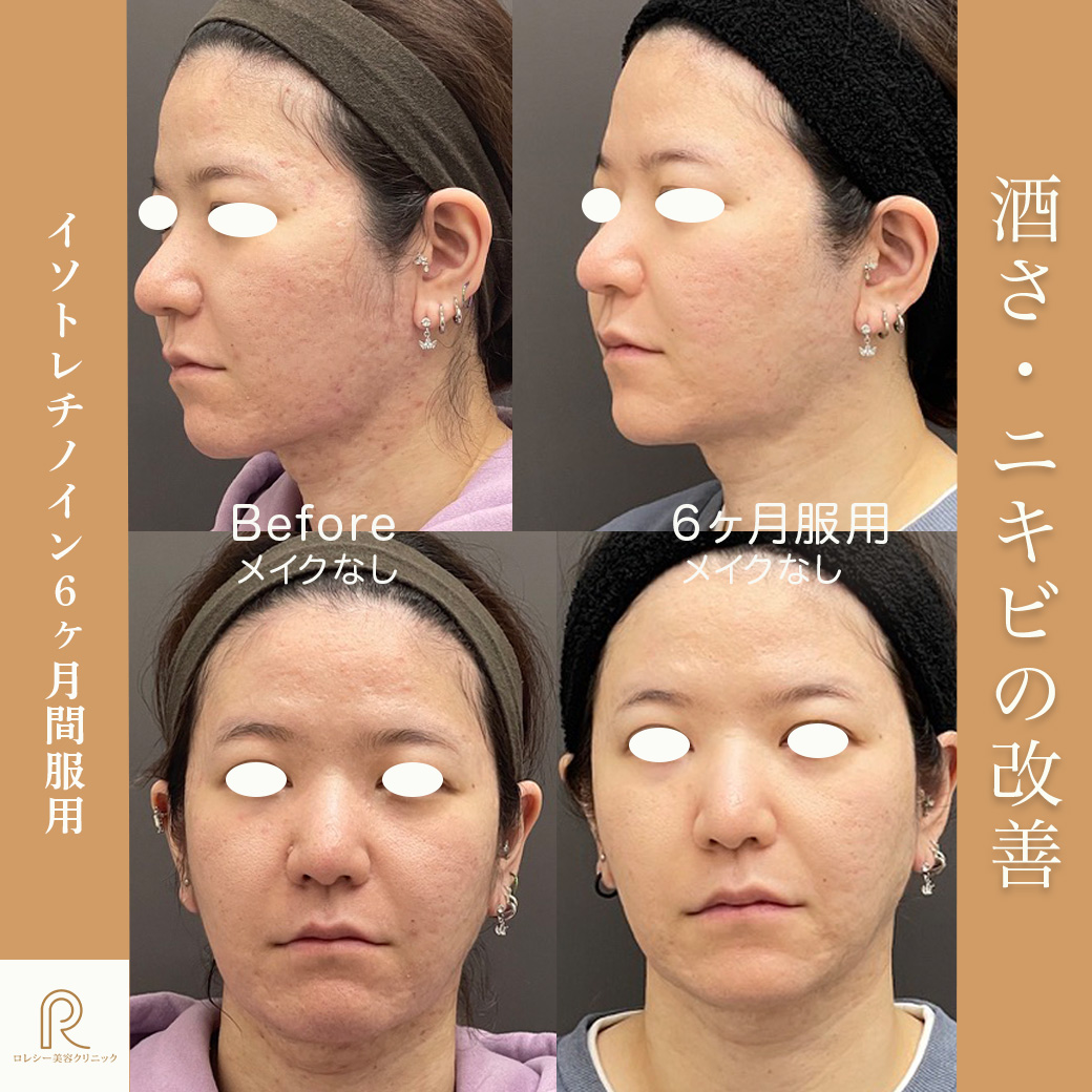 イソトレチノイン(アクネトレント)症例写真